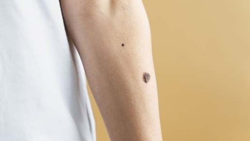 Томичам объяснили, чем могут быть опасны родинки