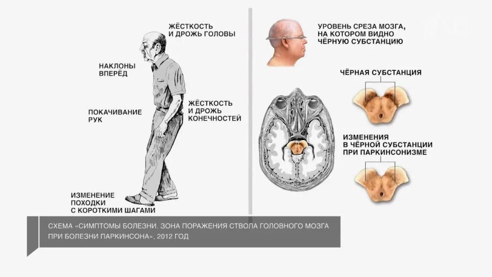 На втором месте после Альцгеймера На втором месте после Альцгеймера
